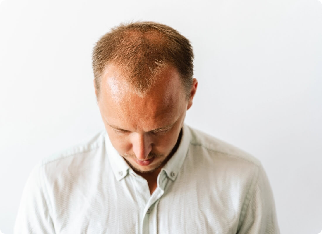 before-hair-transplantation-young-bald-man-with-h-2023-11-27-05-02-18-utc@2x
